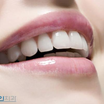 삼성동치과 임플라인이 알려드리는 강남라미네이트 상식과 QnA